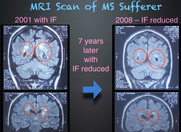 MRI Scan of MS Sufferer with EMF exposure